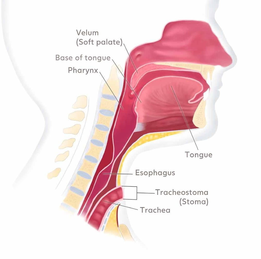Side view of the head and neck after surgery. The windpipe now ends at a stoma in the lower neck and the food pipe runs separately behind it.
